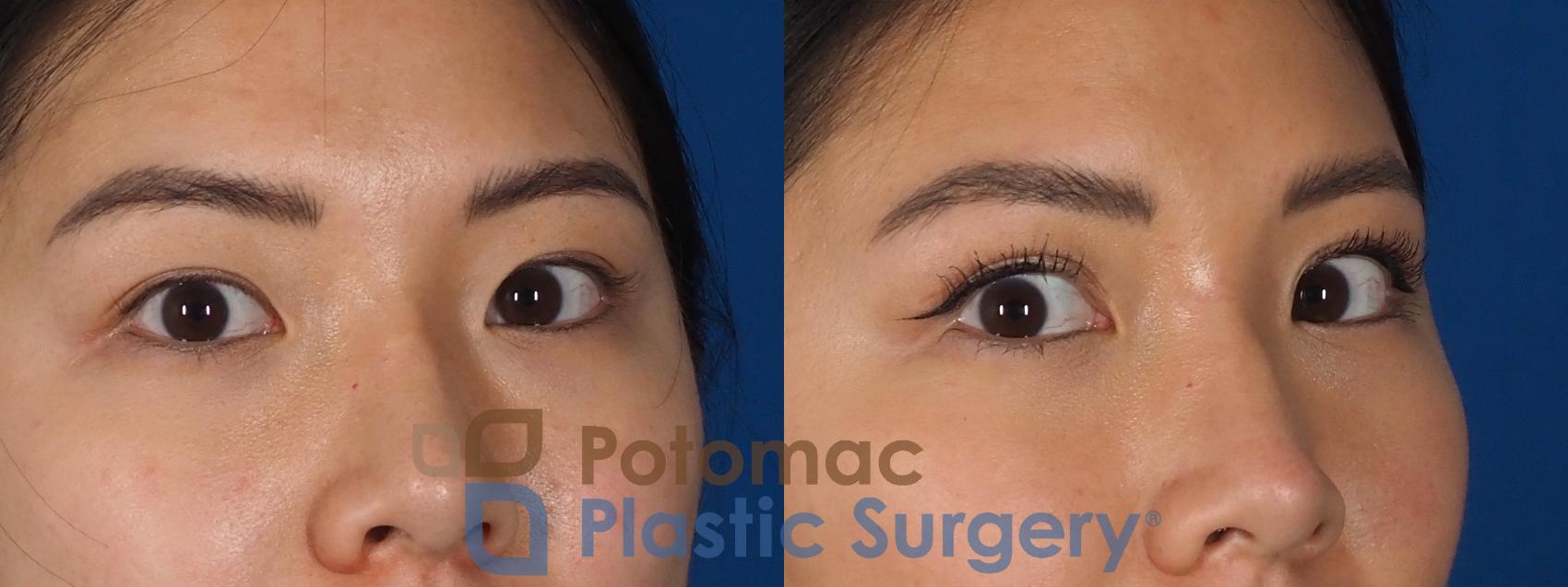 Before & After Asian Eyelid Surgery Case 281 Right Oblique - Looking View in Washington, DC