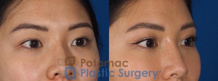 Before & After Asian Eyelid Surgery Case 281 Right Oblique View in Washington, DC