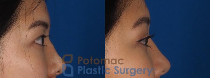 Before & After Asian Eyelid Surgery Case 281 Right Side View in Washington, DC