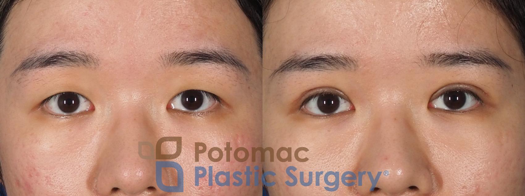 Before & After Asian Eyelid Surgery Case 311 Front View in Washington, DC