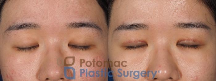 Before & After Asian Eyelid Surgery Case 311 Front - Eyes Closed View in Washington, DC
