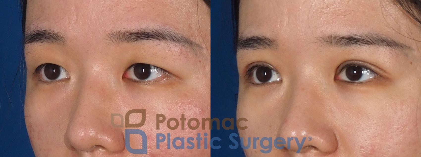 Before & After Blepharoplasty (Eyelid Surgery) Case 311 Left Oblique View in Washington DC & Arlington , DC