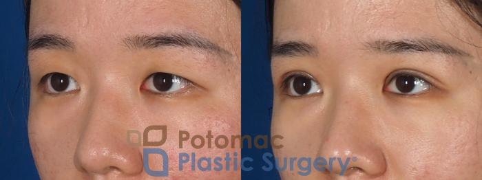 Before & After Asian Eyelid Surgery Case 311 Left Oblique View in Washington, DC