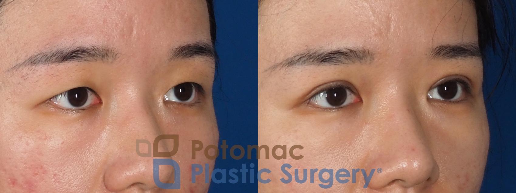 Before & After Blepharoplasty (Eyelid Surgery) Case 311 Right Oblique View in Washington DC & Arlington , DC