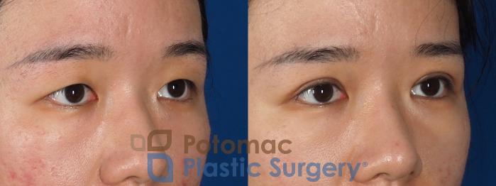 Before & After Asian Eyelid Surgery Case 311 Right Oblique View in Washington, DC