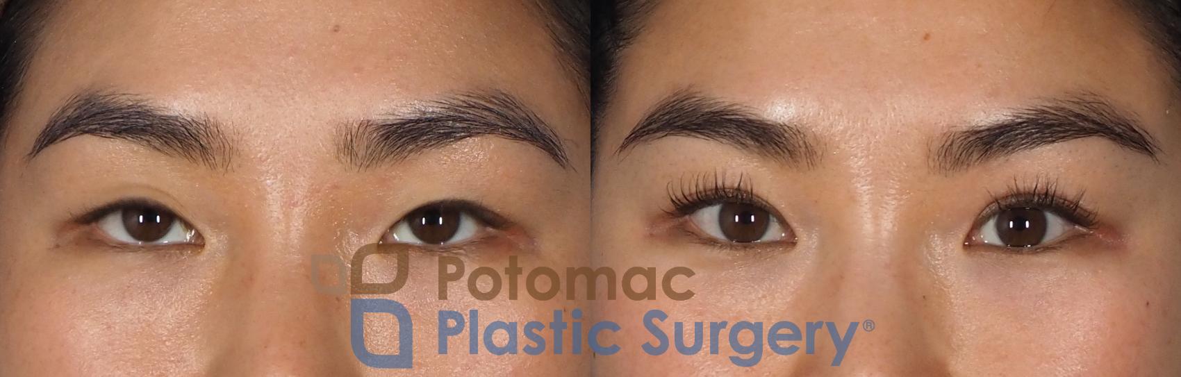 Before & After Asian Eyelid Surgery Case 312 Front View in Washington, DC