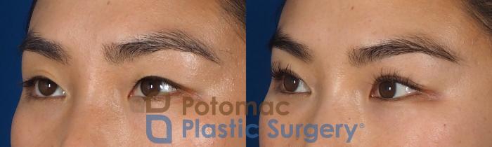 Before & After Asian Eyelid Surgery Case 312 Left Oblique View in Washington DC & Arlington , DC