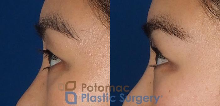 Before & After Asian Eyelid Surgery Case 312 Left Side View in Washington DC & Arlington , DC