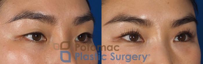 Before & After Blepharoplasty Case 312 Right Oblique View in Arlington, VA & Washington, DC