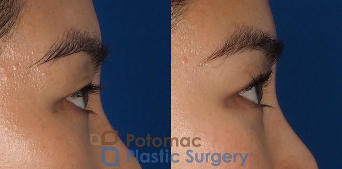 Before & After Blepharoplasty Case 312 Right Side View in Arlington, VA & Washington, DC
