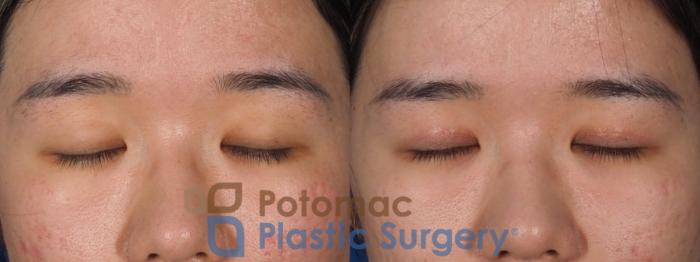 Before & After Asian Eyelid Surgery Case 313 Front - Eyes Closed View in Washington, DC
