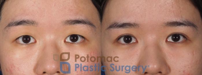 Before & After Asian Eyelid Surgery Case 313 Front View in Washington, DC