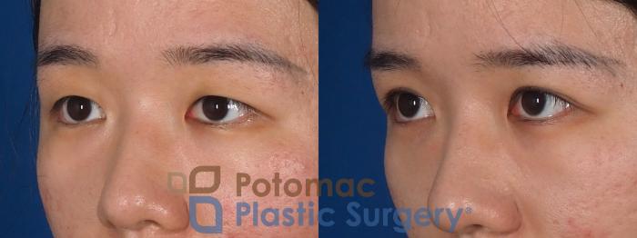 Before & After Asian Eyelid Surgery Case 313 Left Oblique View in Washington, DC