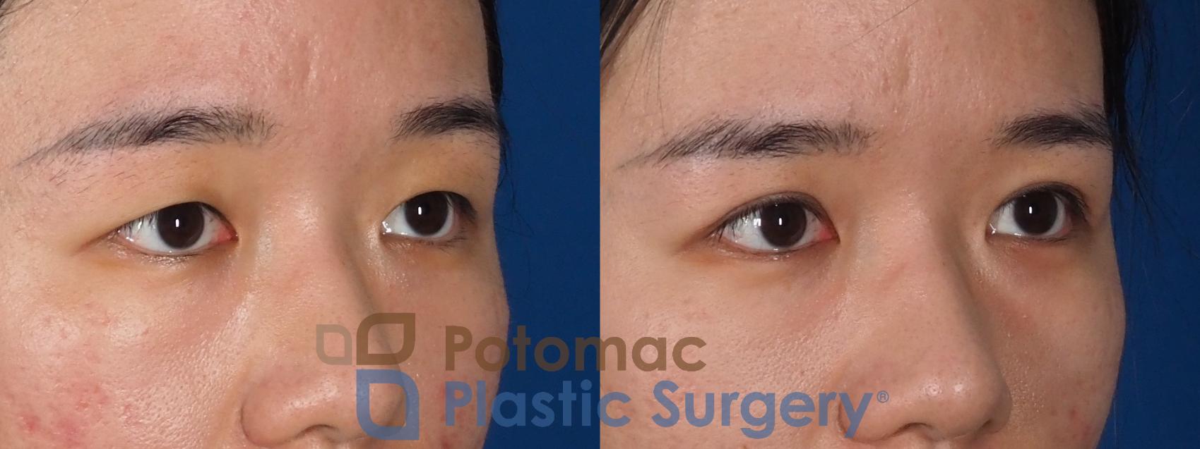 Before & After Asian Eyelid Surgery Case 313 Right Oblique View in Washington DC & Arlington , DC
