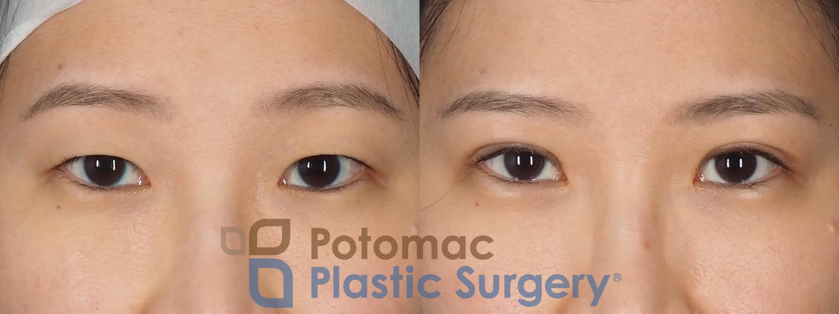 Before & After Asian Eyelid Surgery Case 325 Front View in Washington DC & Arlington , DC