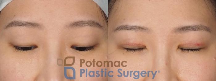 Before & After Asian Eyelid Surgery Case 325 Front - Eyes Closed View in Washington DC & Arlington , DC