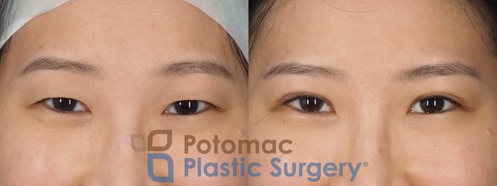 Before & After Asian Eyelid Surgery Case 325 Front - Smiling View in Washington DC & Arlington , DC