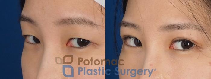 Before & After Asian Eyelid Surgery Case 325 Left Oblique 2 View in Washington DC & Arlington , DC