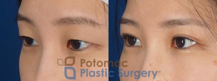 Before & After Asian Eyelid Surgery Case 325 Left Oblique View in Washington DC & Arlington , DC