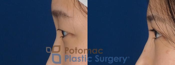 Before & After Asian Eyelid Surgery Case 325 Left Side View in Washington DC & Arlington , DC