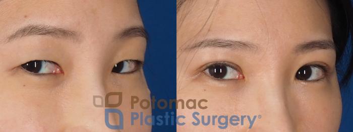 Before & After Blepharoplasty Case 325 Right Oblique 2 View in Washington DC & Arlington , DC