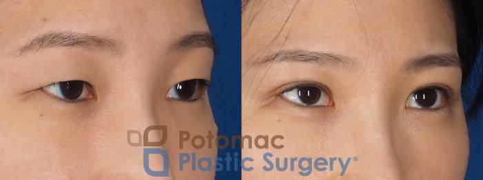 Before & After Asian Eyelid Surgery Case 325 Right Oblique View in Washington DC & Arlington , DC