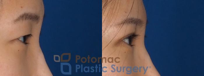 Before & After Blepharoplasty Case 325 Right Side View in Washington DC & Arlington , DC
