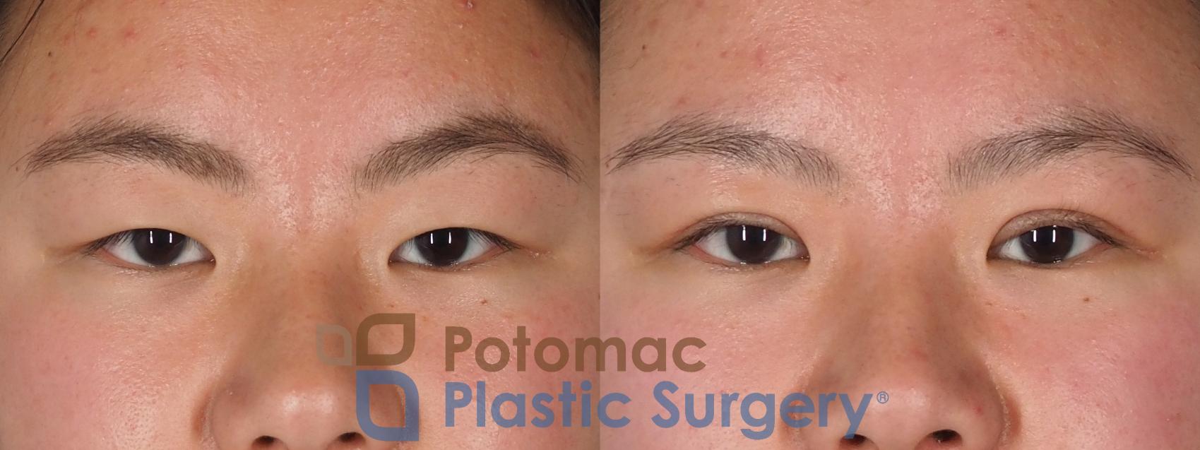 Before & After Asian Eyelid Surgery Case 330 Front View in Washington DC & Arlington , DC