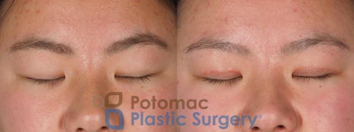 Before & After Asian Eyelid Surgery Case 330 Front - Eyes Closed View in Washington DC & Arlington , DC