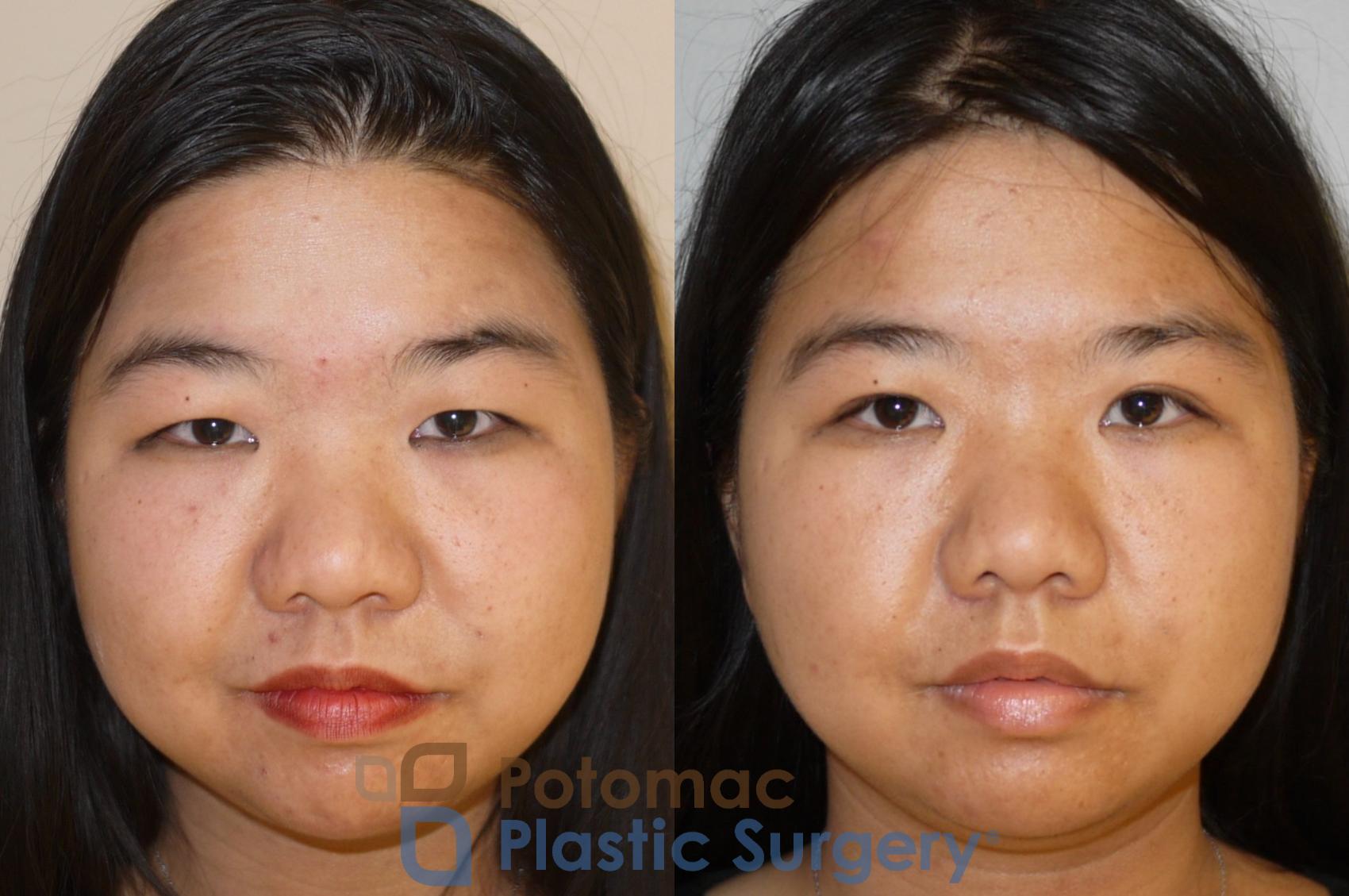 Before & After Blepharoplasty Case 58 Front View in Washington, DC