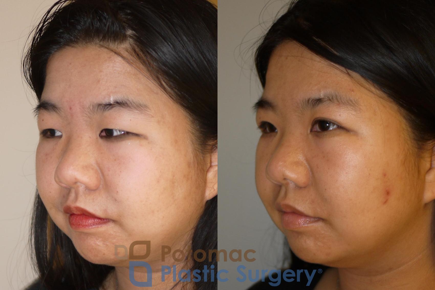 Before & After Asian Eyelid Surgery Case 58 Left Oblique View in Washington, DC
