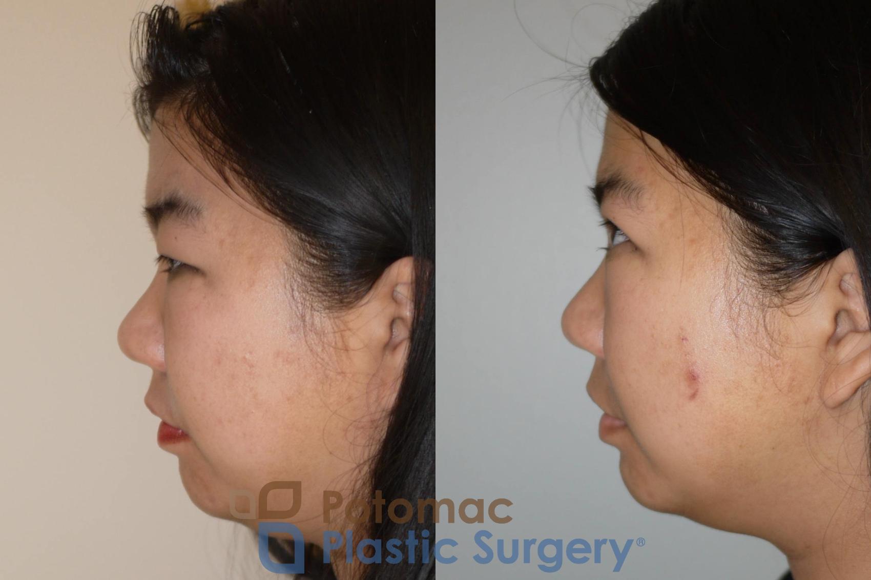 Before & After Asian Eyelid Surgery Case 58 Left Side View in Washington DC & Arlington , DC