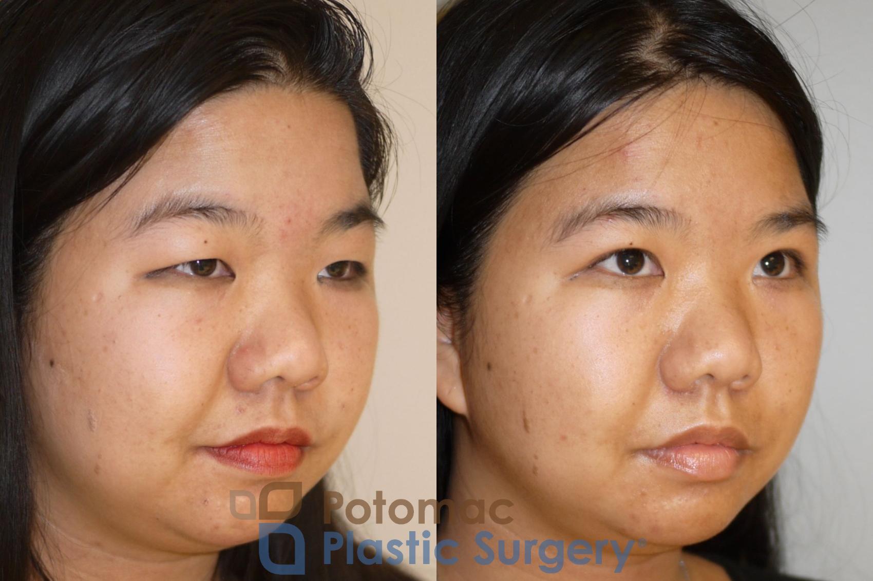 Before & After Asian Eyelid Surgery Case 58 Right Oblique View in Washington, DC
