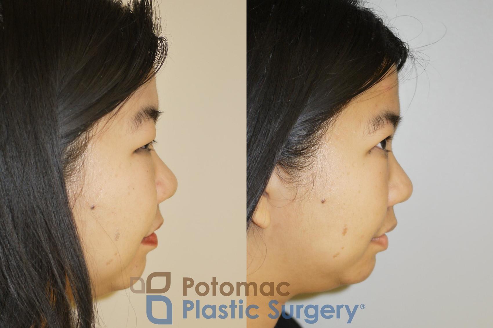 Before & After Asian Eyelid Surgery Case 58 Right Side View in Washington, DC