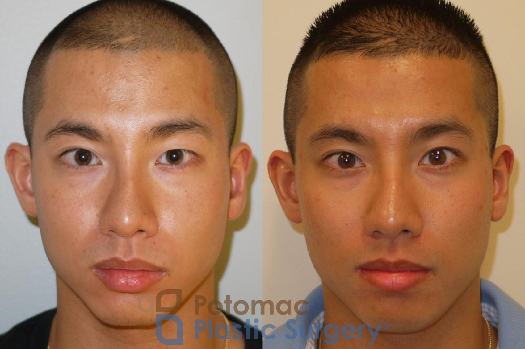 Before & After Asian Eyelid Surgery Case 65 Front View in Washington DC & Arlington , DC