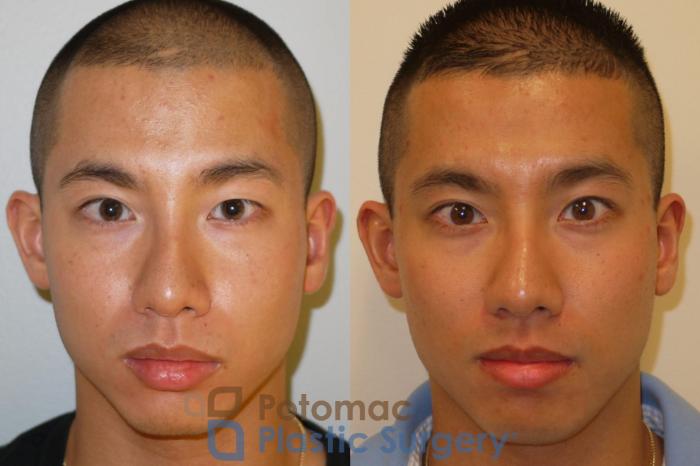 Before & After Asian Eyelid Surgery Case 65 Front View in Washington, DC
