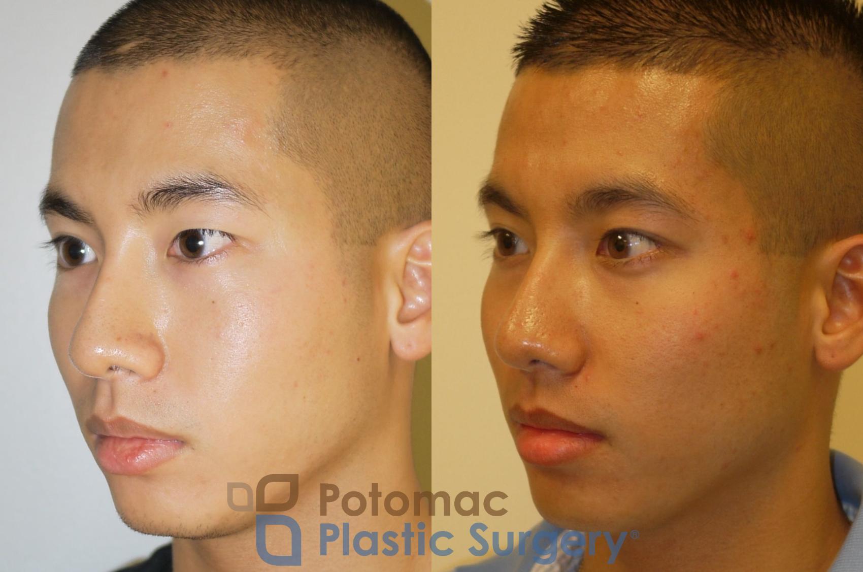 Before & After Asian Eyelid Surgery Case 65 Left Oblique View in Washington, DC