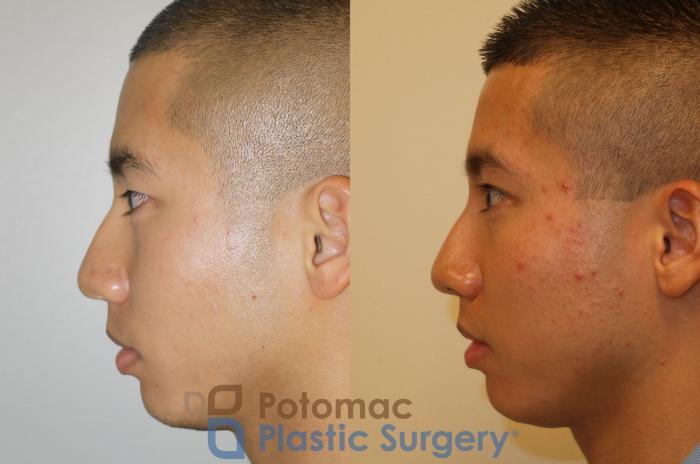 Before & After Asian Eyelid Surgery Case 65 Left Side View in Washington, DC