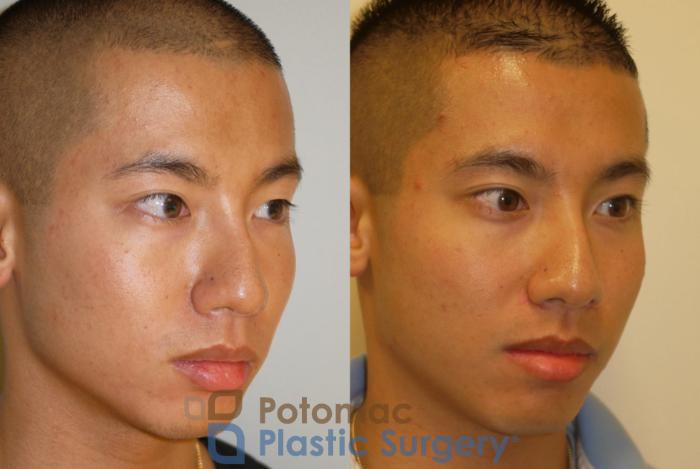 Before & After Asian Eyelid Surgery Case 65 Right Oblique View in Washington, DC
