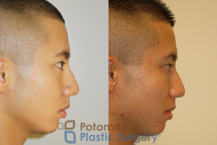Before & After Asian Eyelid Surgery Case 65 Right Side View in Washington, DC