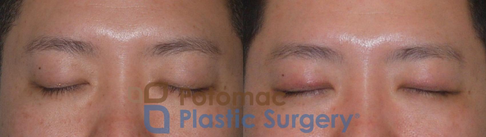 Before & After Blepharoplasty (Eyelid Surgery) Case 95 Front View #2 View in Washington DC & Arlington , DC
