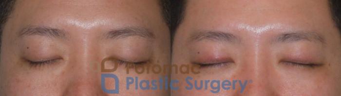 Before & After Blepharoplasty Case 95 Front View #2 View in Washington DC & Arlington , DC