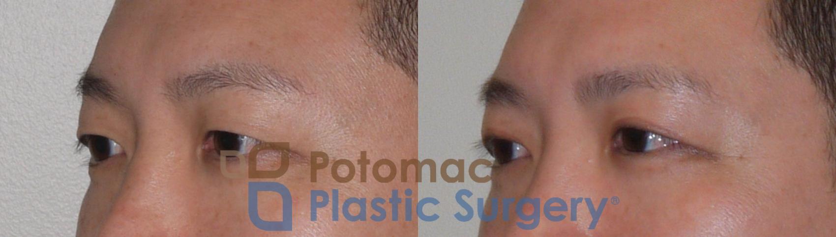 Before & After Blepharoplasty (Eyelid Surgery) Case 95 Left Oblique View in Washington DC & Arlington , DC