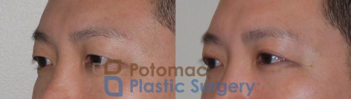 Before & After Asian Eyelid Surgery Case 95 Left Oblique View in Washington DC & Arlington , DC