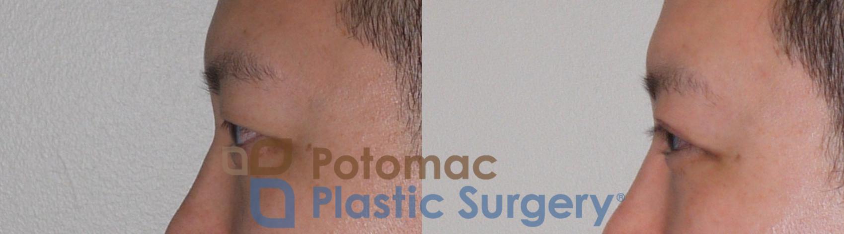 Before & After Asian Eyelid Surgery Case 95 Left Side View in Washington, DC