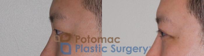Before & After Asian Eyelid Surgery Case 95 Left Side View in Washington DC & Arlington , DC