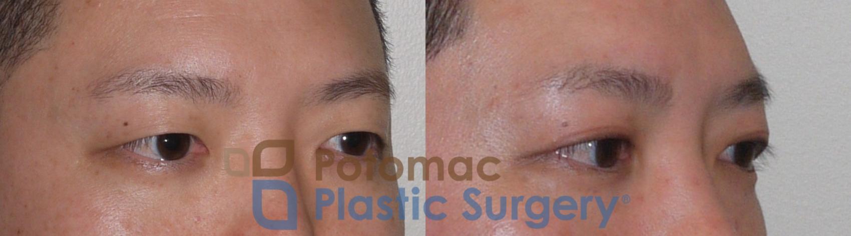 Before & After Blepharoplasty Case 95 Right Oblique View in Washington, DC
