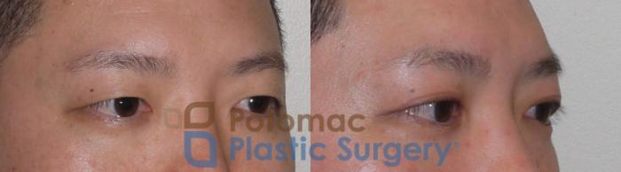 Before & After Asian Eyelid Surgery Case 95 Right Oblique View in Washington DC & Arlington , DC