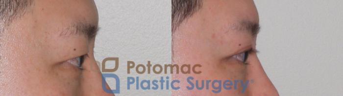 Before & After Asian Eyelid Surgery Case 95 Right Side View in Washington DC & Arlington , DC