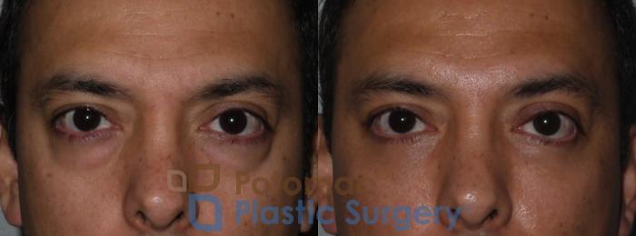 Before & After Blepharoplasty Case 117 Front View in Washington, DC